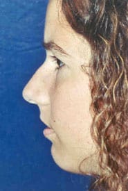 Rhinoplasty 08 Before 3