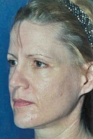 Facelift 09 Before 2