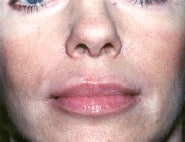 Lip Lift / Augmentation 02 After 1