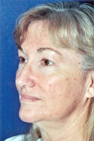 Neck Lift 04 Before 2