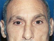 Eyelid Surgery 10 Before 1