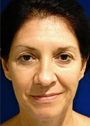 Facelift 03 Before 1