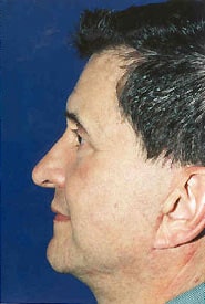 Facelift 10 After 3