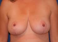 Breast Lift 04 After 1