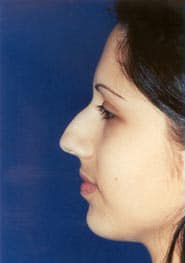 Rhinoplasty 07 Before 3