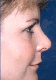 Rhinoplasty 06 After 3