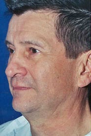 Facelift 10 Before 2