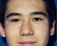 Rhinoplasty 01 Before