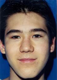 Rhinoplasty 01 Before 1
