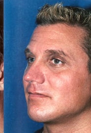 Buccal Fat Removal 02 After 3