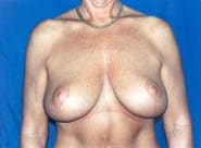 Breast Lift 05 After 1