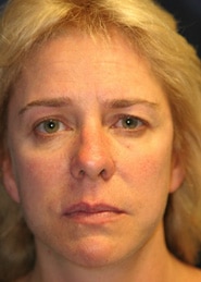 Facelift 02 Before 1