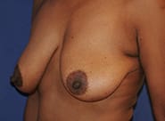Breast Lift 02 Before 2