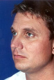 Buccal Fat Removal 02 Before 3