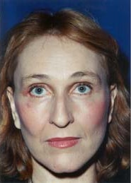 Brow Lift 01 After 1