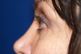 Eyelid Surgery 02 After 3