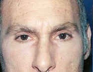 Eyelid Surgery 10 After 1