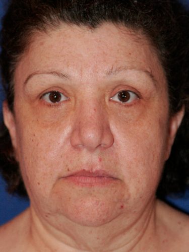 Neck Lift 02 Before 1