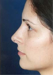 Rhinoplasty 04 After 2