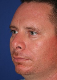 Chin Implants 01 Before 3