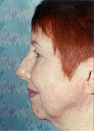 Facelift 07 Before 3