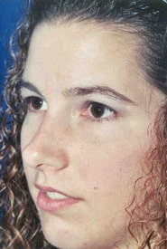 Rhinoplasty 08 After 2