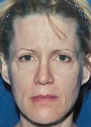 Facelift 09 Before 1