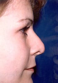 Rhinoplasty 06 Before 3