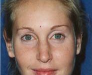 Chin Implants 02 Before