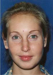 Chin Implants 02 Before 1