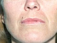 Lip Lift / Augmentation 03 Before 1