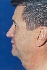 Facelift 10 Before 3