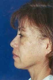 Facelift 11 Before 3