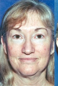 Neck Lift 04 Before 1