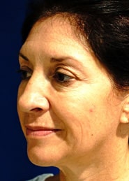 Facelift 03 Before 2