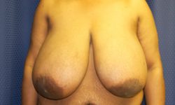 Breast Reduction 03 Before