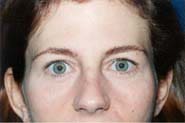 Brow Lift 02 Before 1