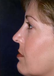 Chin Implants 03 After 2