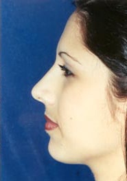 Rhinoplasty 07 After 3