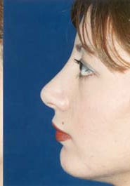 Rhinoplasty 03 After 3