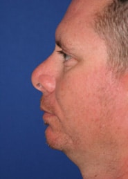 Chin Implants 01 Before 2