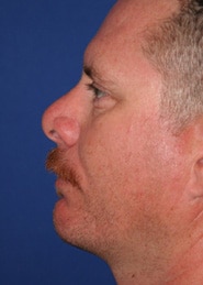 Chin Implants 01 After 2