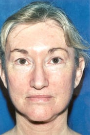 Neck Lift 04 After 1