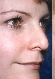 Rhinoplasty 06 Before 2