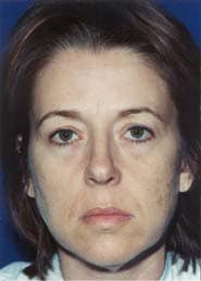 Facelift 06 Before 1