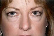 Eyelid Surgery 07 Before 1