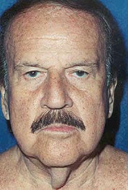 Neck Lift 03 Before 1