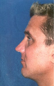 Buccal Fat Removal 02 After 2