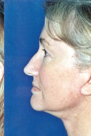 Neck Lift 04 After 3