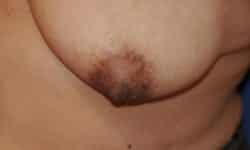 Inverted Nipple Repair 01 After